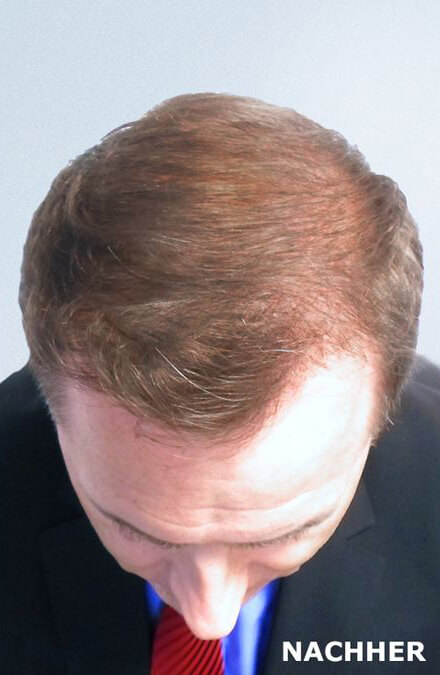 Resultate Unserer Haartransplantationen Hairdoc Dr Neidel